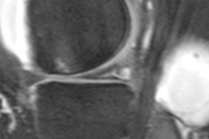Typischer, grosser Meniskusriss im MRI (Magnetresonanztomographie)